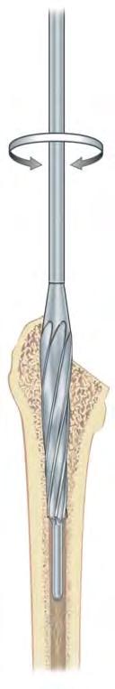 Stay posterior and lateral in order to obtain a neutral stem position (Figure 3).
