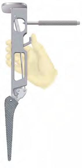 Femoral Canal Preparation 4. Femoral Broaching Assemble the broach to the broach handle by placing the broach post in the clamp. Use the thumb to lock the clamp onto the broach.
