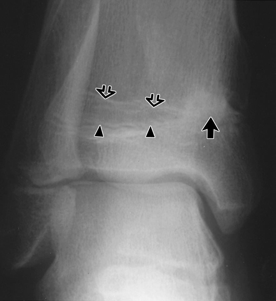 The posttraumatic bridges tended to be located distally in a bone (71/78), particularly the distal tibia, femur, and radius.