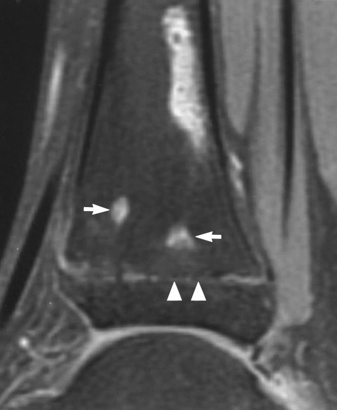 MR Imaging of Physeal Arrest in Children whereas smaller bridges that had variable signal intensity were often hypointense (32/65).