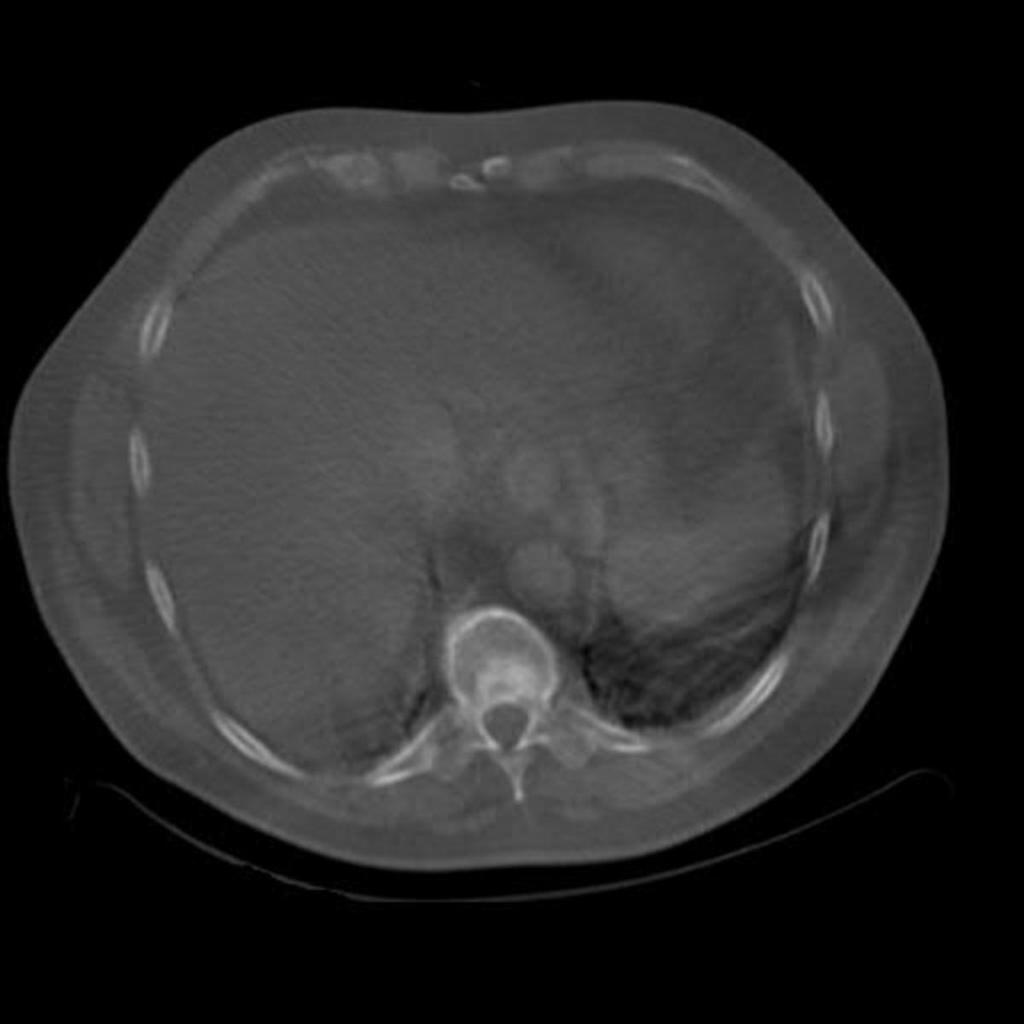 Fig.: Case 2: CT component showing T10 sclerotic lesion. Case 3 A 63 year old male with hormone resistant Prostate cancer presented with back pain.