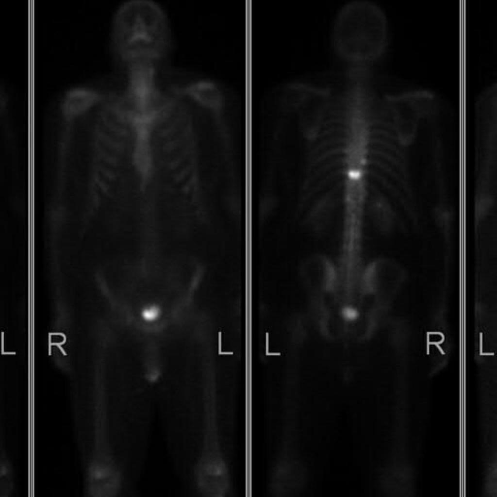 strongly suggested by the whole body imaging, the scintigraphic pattern can be mimicked by benign disease (see case 3).