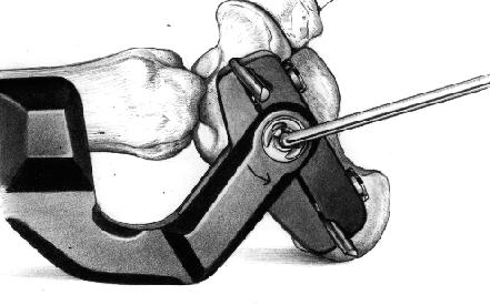 E. Attach fixator body to ankle clamp at the inner body rotation component by means of a locking connector bolt.