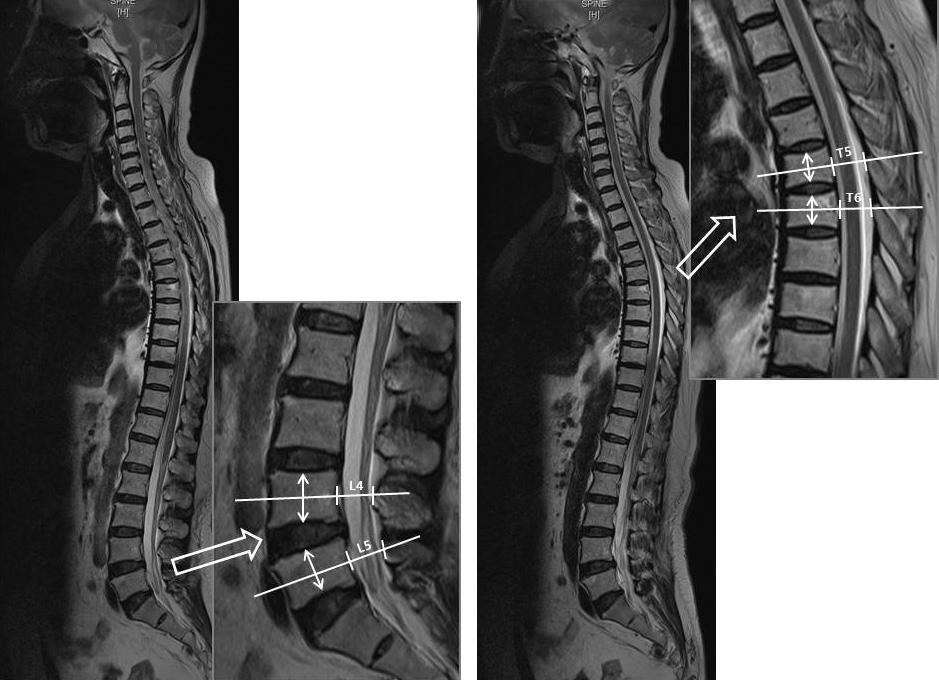 Spinal Canal Diameter Change According to Age the most frequent indication for spinal surgery in people over 6 years old.