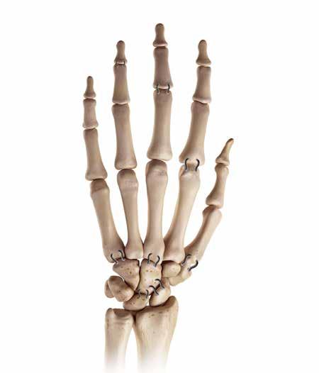 Akin Osteotomies: 7x5 1.2mm,9x7 1.2mm 7. Cotton Procedure: 20x20,18x18x15 8. Lapidus ProcedureL 20x20,18x18x15 Dorsally / 15x12 Medially 9.