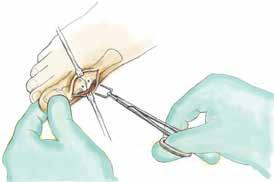 Fig. 5 Staple Handling and Implantation Always use hemostats or the provided staple