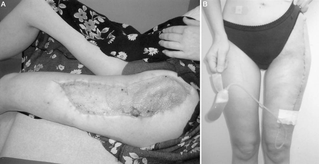 Case Report: Chevray and Singh: TFL to Gastroepiploics Fig 3. (A) Left lateral thigh TFL flap donor site, which required skin graft closure.