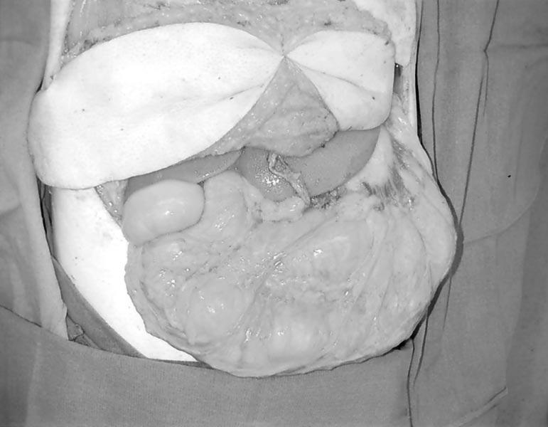 Case Report: Chevray and Singh: TFL to Gastroepiploics Fig 9. The free tensor fascia lata musculofasciocutaneous flap is shown lying on the liver, anastomosed to the left gastroepiploic vessels.