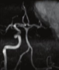 Stage IIH c2 [1]. Axial diffusion weighted MR images reveal areas of restricted diffusion remote from the area of hemorrhage (arrow heads).