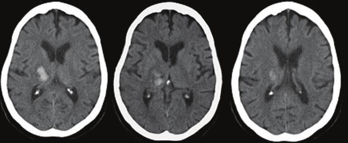2 Radiology Research and Practice Figure 1: 75-year-old woman presented with left hemiparesis and