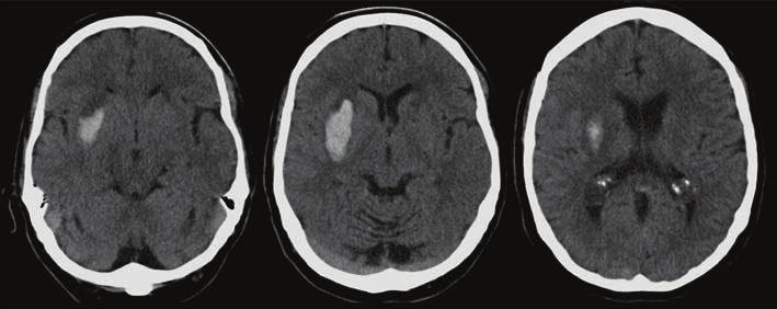 Cerebral blood flow images show an area of decreased flow matching the area of the hematoma.