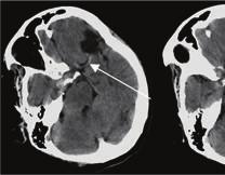 Initial axial unenhanced CT images show an old left frontal infarct only.