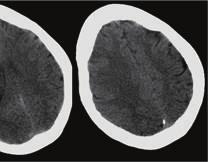 (c) Axial unenhanced CT images 24 hours after stroke show a large left parenchymal