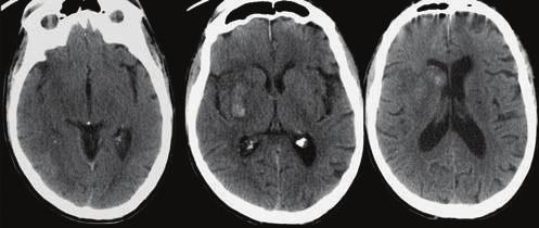 4 Radiology Research and Practice (e) (c) (d) Figure 5: 69-year-old man with atrial fibrillation on warfarin, he presented with a 2-day history of left hemiparesis and