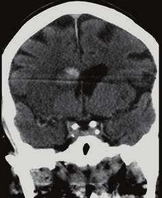 region. The cessation of warfarin after the first stroke probably contributed to this cardioembolic stroke.