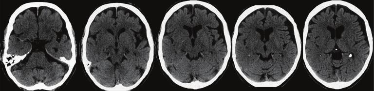 Radiology Research and Practice 5 (c) (d) Figure 6: 82-year-old man presented with left hemiparesis.