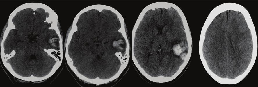 6 Radiology Research and Practice Figure 7: 43-year-old woman presented with acute confusion with no history of trauma.