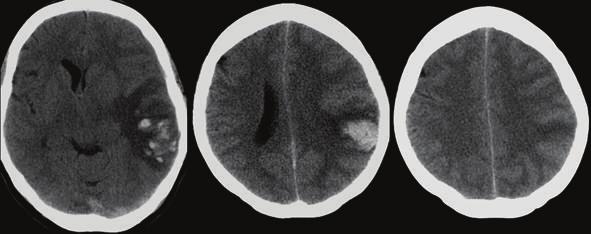 Figure 8: 57-year-old woman presented with dysphasia, headache, and vomiting.