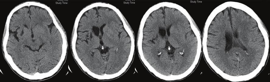 Radiology Research and Practice 7 Figure 9: 78-year-old man presented with right hemiparesis and dysphasia.