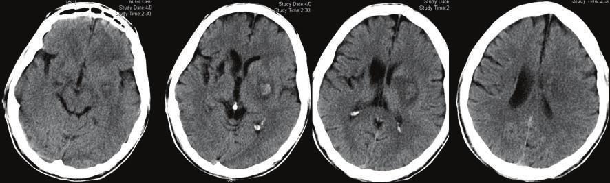 Repeated axial unenhanced CT images 3 days later show a parenchymal hematoma within the area of infarct. Stage HI d2 [1].