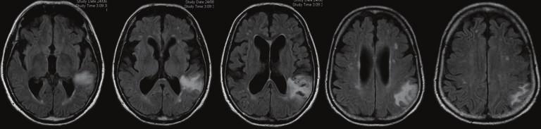 Axial unenhanced CT images show an acute left parietal hemorrhage.