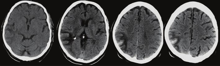 Axial unenhanced CT images 10 days after stroke show a hemorrhage within a wedge-shaped infarct in the right posterior parietal lobe.