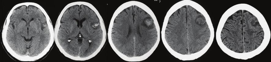 Figure 12: 60-year-old man presented with dysphasia and confusion for 2 days.