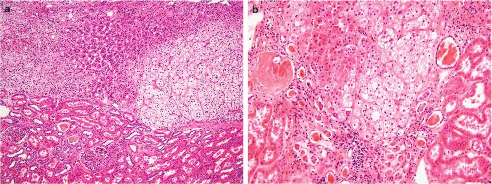 177 Figure 1 Adrenal tissue in direct contact with renal cortex with no intervening fibrous