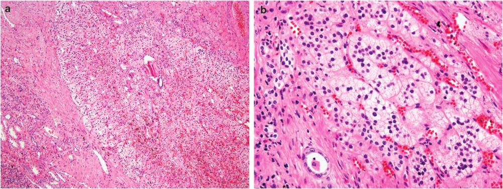 Ectopic adrenal tissue varied in its growth from subcapsular lesions that were plaque-like (n ¼ 3), wedge-shaped (n ¼ 2), or spherical (n ¼ 1) to irregular nests deep in the renal parenchyma (n ¼ 1)