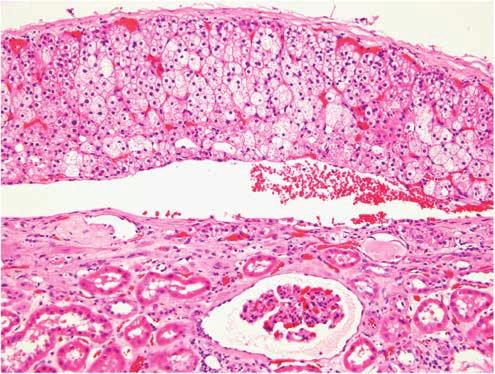 At the base of the subcapsular adrenal tissue, a complete fibrous septum separating the adrenal tissue from the renal parenchyma was present in only one case with incomplete septa in four cases.