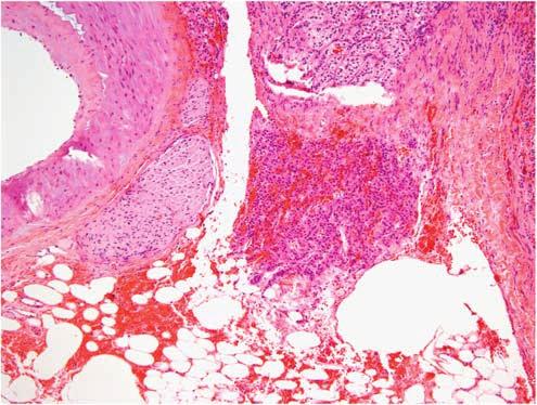 Figure 8 Ectopic adrenal tissue extends from subcaspular region into perirenal adipose tissue without a surrounding fibrous capsule. of ectopic adrenal tissue, at the interface of renal tissue.