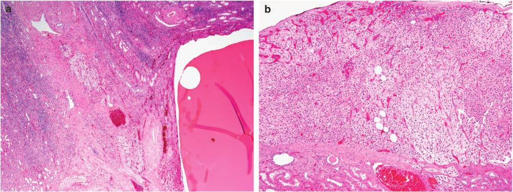 180 Figure 9 Case 2. Deformed blood vessels intertwined with ectopic adrenal tissue in deep renal parenchyma (a). Scattered adipocytes in subcapsular ectopic adrenal tissue in case 4 (b).