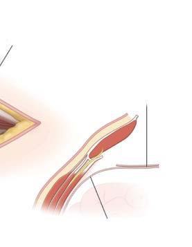 Posterior Rectus Fascia Peritoneum Figure 5 Incisional hernia repair. Illustrated is a retromuscular approach.