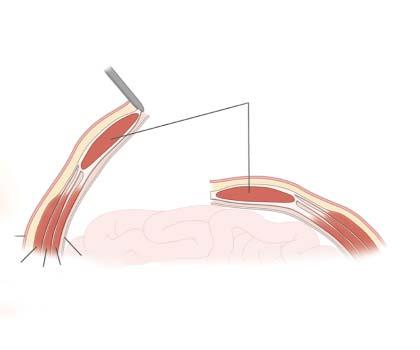bundles; denervation or abdominal wall necrosis is possible if these bundles are injured. (b) The prosthesis is prepared with U-shaped sutures.