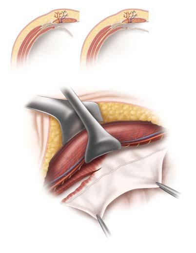 gastro repair of ventral abdominal wall hernias 18 Preperitoneal Plane Transversus Abdominis Release (TAR) a Superficial Epigastric Vessels Branches of Inferior Epigastric Vessels 1 A 1 A 2 Anterior