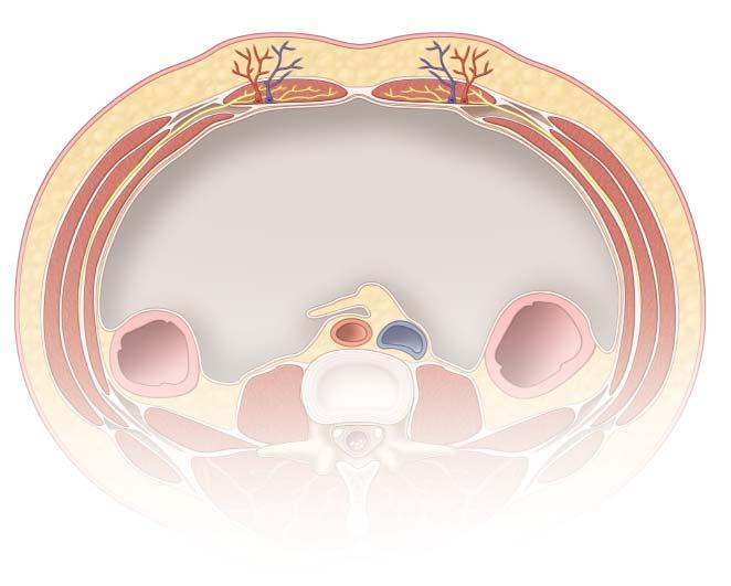 gastro repair of ventral abdominal wall hernias 4 Linea Alba Rectus Abdominis Muscle Linea Semilunaris Subcutaneous Tissue Neurovascular Bundle External Abdominal Oblique Muscle Internal Abdominal