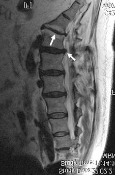 313 Radiological Evaluation Anteroposterior (AP) and lateral standing radiograms of each patient s lumbar spine were obtained preoperatively and