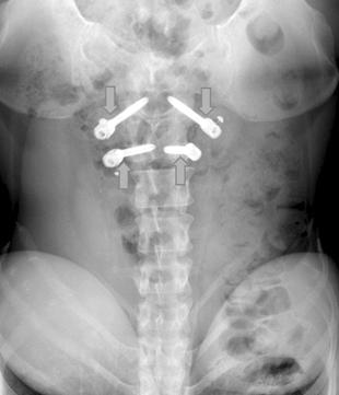314 A B C D Fig. 4. A 47-year-old female patient had severe back pain attacks for a total of 8 years with 4 severe attacks occurring in the most recent year. Each pain episode lasted 1 week.