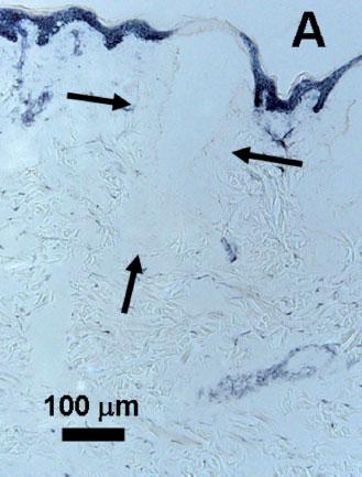 90 HANTASH ET AL. Fig. 2. Ex vivo human abdominal tissue treated with the 30 W, 10.6 mmco 2 laser at 9.