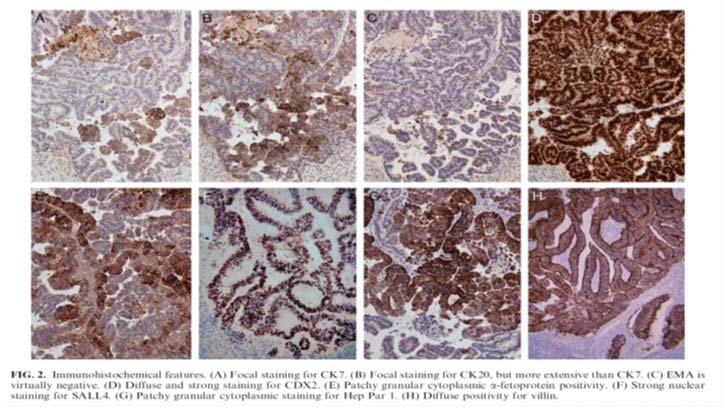 the female genital tract in older adults derive commonly from somatic epithelial neoplasms: somatically derived yolk sac tumours Histopathology 2016: DOI:10.1111/his.