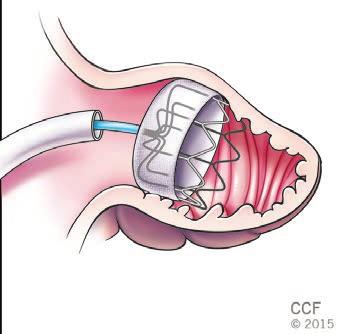 WATCHMAN device CATHETER WATCHMAN DEVICE is a small, ear-shaped cavity located in the left atrium and in which clots tend to form in patients with atrial fibrillation.