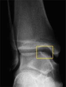 fibula; it is not uncommon for the fracture to be evident on the mortise and lateral views only (Figure 4). Management.