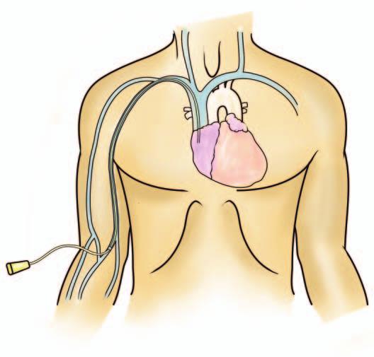 Tunneled devices may be cuffed or noncuffed; the former devices have a polyethylene or silicone flange that anchors the catheter within the subcutaneous tissue and limits entry of bacteria along the