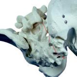 Operative Technique Sacrum Fracture Longitudinal posterior approach. Fixation of a sacrum fracture by placing two 6.