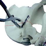 Reduction of acetabular fractures are best performed on the orthopedic extension table allowing