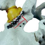 5mm independent Lag-Screws maintain the transverse fracture.