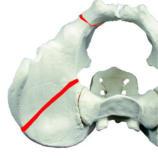 1cm to 2cm above the acetabulum. One 3.