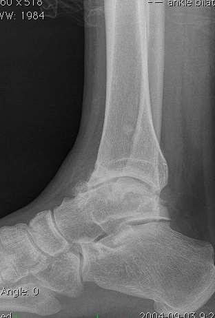Introduction Ankle fusion (AF) and Replacement (TAR) are accepted treatments for end stage ankle arthritis (ESAA) While AF is reliable, TAR is often preferred by patients