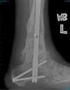 procedure requiring 2nd incision Ligament recon or release, TAL, GSR, ESAA with: ESAA with: Tibial or HF or MF ST, TN or CC arthritis