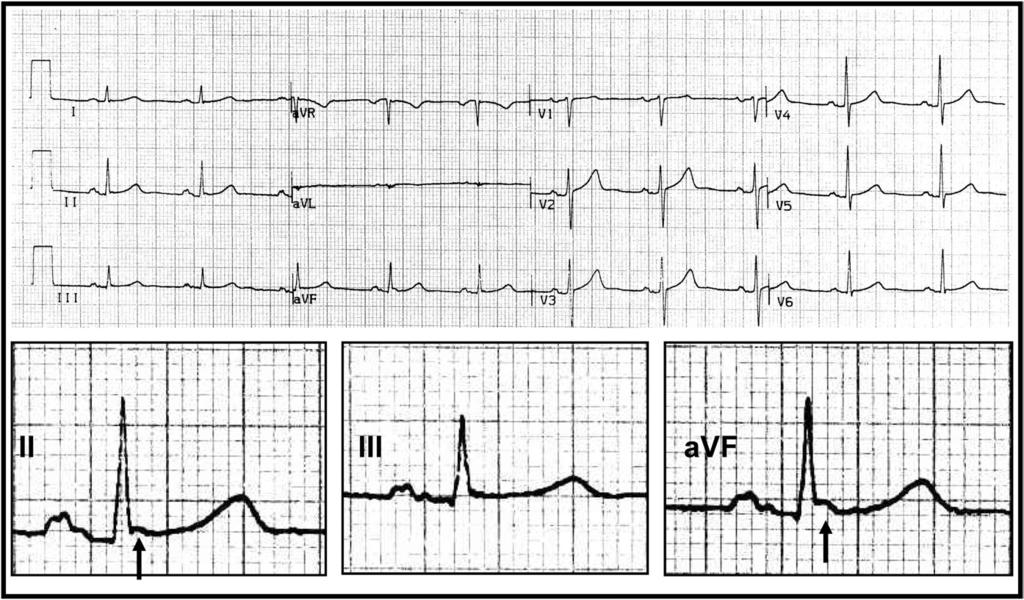 Rosso et al Distinguishing Benign from Malignant Early Repolarization 227 Figure 2 Electrocardiogram of a male patient with idiopathic ventricular fibrillation with J waves in the inferior leads.